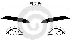 Medical illustrations, diagrammatic line drawings of eye diseases, strabismus and exotropia