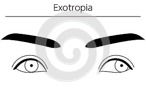 Medical illustrations, diagrammatic line drawings of eye diseases, strabismus and exotropia photo