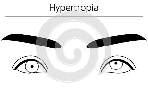 Medical illustrations, diagrammatic line drawings of eye diseases, strabismus and hypertropia photo