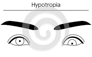 Medical illustrations, diagrammatic line drawings of eye diseases, strabismus and hypotropia