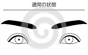 Medical illustrations, diagrammatic line drawings of eye diseases, strabismus and normal conditions