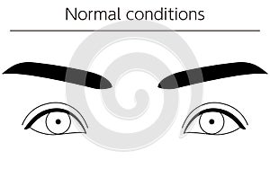 Medical illustrations, diagrammatic line drawings of eye diseases, strabismus and normal conditions