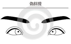 Medical illustrations, diagrammatic line drawings of eye diseases, strabismus and pseudostrabismus