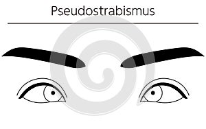 Medical illustrations, diagrammatic line drawings of eye diseases, strabismus and pseudostrabismus