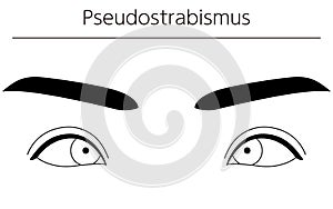 Medical illustrations, diagrammatic line drawings of eye diseases, strabismus and pseudostrabismus photo