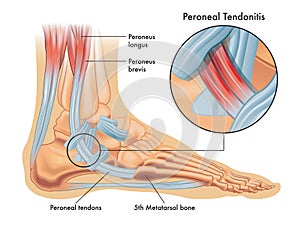 Medical illustrations of symptoms of peroneal tendonitis photo