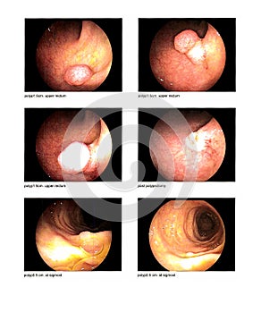 Medical image Gastrointestinal endoscopic examination image Finding polyp upper rectum and sigmoid with post polypectomy Image