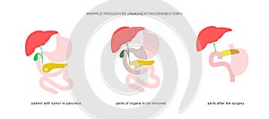 Medical infographic of whipple procedure pancreaticoduodenectomy with gastrojejunostomy. Surgery operation in treatment