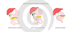 Medical infographic of whipple procedure pancreaticoduodenectomy. Surgery operation in treatment of pancreatic cancer.