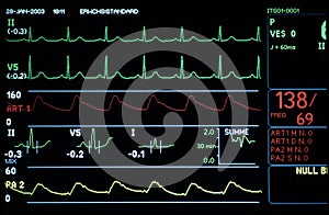 La pantalla de un monitor médico con ecg, presión sanguínea y la curva de saturación de oxígeno de la curva.