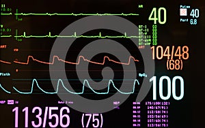 Medical Monitor Showing Slow Heart Rate or Bradycardia