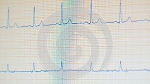 Medical monitor with changing readings of EKG. ECG monitor shows healthy heart beat.