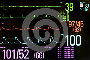 Medical Monitor Showing Bradycardia and Hypotension