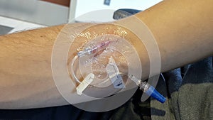 Medical patient with Iv needle in arm