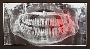 Medical radiography or radiology of dental teeth examination