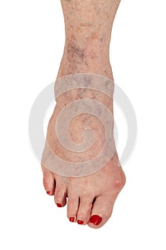 Medical: Rheumatoid Arthritis, Hammer Toe and Varicose veins