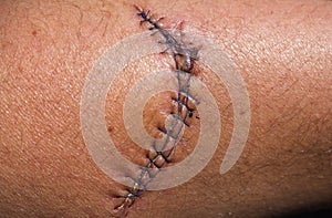 Medical stitches photo
