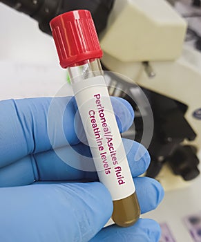 Fluid sample for peritoneal fluid Creatinine levels. Ascites creatinine. photo