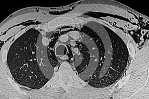 CT scan showing pneumomediastinum, subcutaneous emphysema, and right-sided pneumonia photo