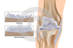Medical vector illustration with damaged knee structure and healthy knee comparison. Knee arthrosis.
