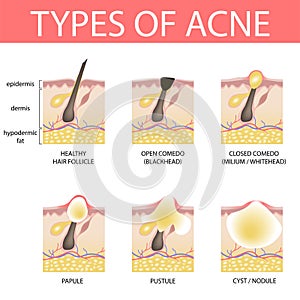 Medical vector illustration of different types of acne on human skin. Appearance of pimples in hair follicle