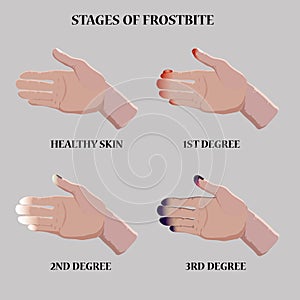 Medical vector illustration. Frostbite stages. Blue and red frostbitten fingers.  Stages of hypothermia in cold season
