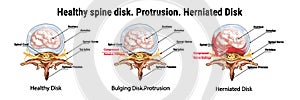 Healthy spine disk. Protrusion. Herniated Disk. Bulging Disk. The anatomical structure of the spine. Compressed nerve endings. photo