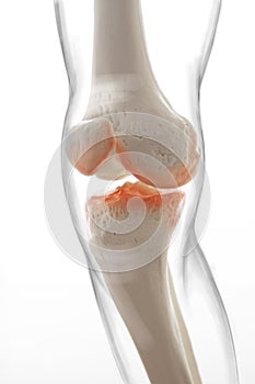 Medically accurate representation of an arthritic knee joint, knee meniscus, human leg, 3d illustration