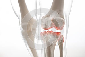 Medically accurate representation of an arthritic knee joint, knee meniscus, human leg, 3d illustration