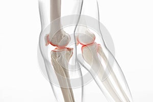 Medically accurate representation of an arthritic knee joint, knee meniscus, human leg, 3d illustration photo