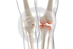 Medically accurate representation of an arthritic knee joint, knee meniscus, human leg, 3d illustration photo