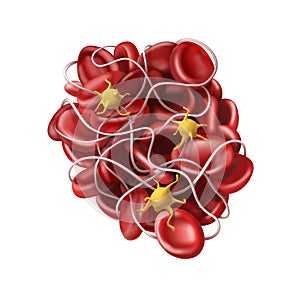 Medicine. A blood clot or thrombus - coagulation