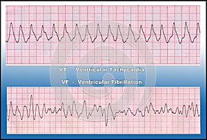 Medicine - Deadly Heart Arrhythmia - VT & VF photo