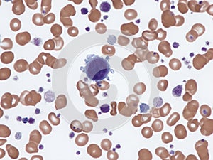 Megakaryoblast in peripheral blood.