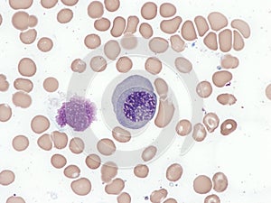 Megaloblastic anemia, bone marrow.