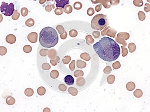Megaloblastic anemia, bone marrow.