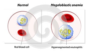 Megaloblastic anemia. photo