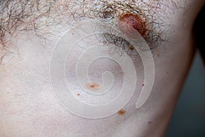 Melanocytic nevus, some of them dyplastic or atypical, on a caucasian man of 36 years old