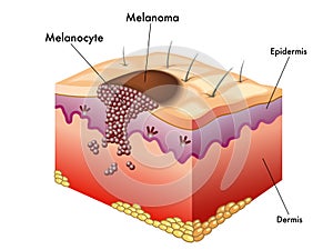 Melanóm 