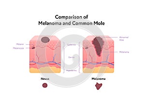 Rakovina anatomický plakát. vektor byt zdravotní ilustrace. srovnání z nádor a společný krtek 