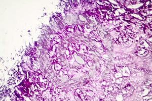 Melanoma, a cancer developing from pigment-containing cells melanocytes photo