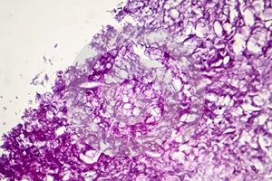 Melanoma, a cancer developing from pigment-containing cells melanocytes