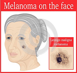 Melanoma on the cheek photo
