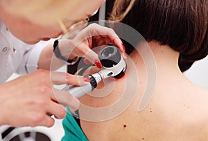 Melanoma diagnoinspectionsis. the doctor examines the patient`s mole