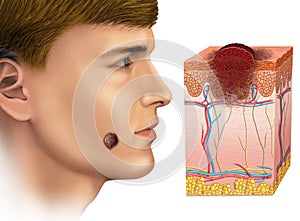 Melanoma on the face