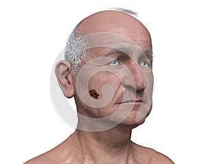 Melanoma on face skin, computer illustration