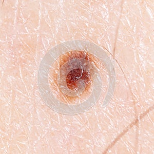 Melanoma on the human skin as a background