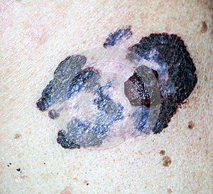 Melanoma