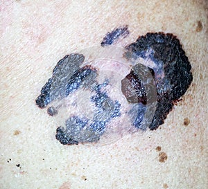 Melanoma photo