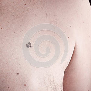 Melanoma on skin photo